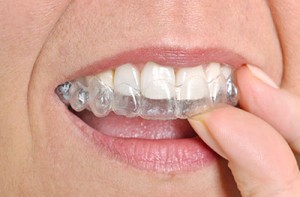 Invisalign - The Clear Alternative to Braces
